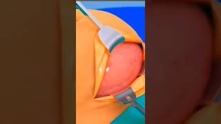 A fully Caesarean section 3D Animation...#baby #gynaecologists #obstetrics #mbbsstudent #trending