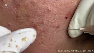 Big Cystic Acne Blackheads Extraction Blackheads & Milia, Whiteheads Removal Pimple Popping