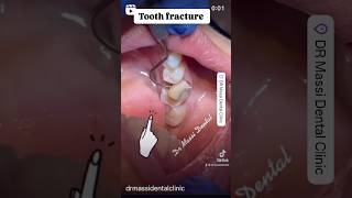 Fracture of tooth