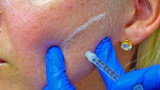 Botox Procedure on Masseters at a Local Med Spa In San Antonio Texas!