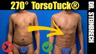 270° TorsoTuck® with BodyBanking® by Dr. Steinbrech of Alpha Male Plastic Surgery