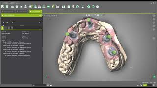 DWOS - Create Custom Abutments