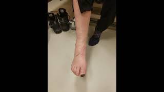 Look Doctor Dellon!! Foot movement 3 months after surgery- CPN Kirsten Bey post op new