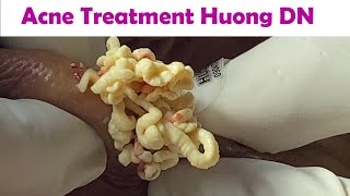 Acne Treatment Huong Da Nang# _ 2024   #Acne Huong 715