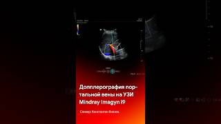 Допплерографии портальной вены на Mindray Imagyn i9 #shorts #short #tiktok #reels #medical #узи