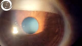 Ophthalmic Signs Anterior Segment