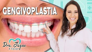 Gengivoplastia - Dra. Jaque Akemi - Londrina - PR