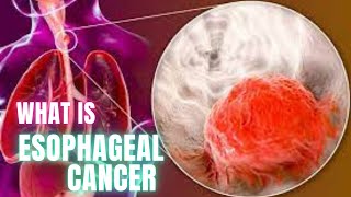 What is Esophageal Cancer? How Esophageal Cancer causes and treatment? | Dr Academy