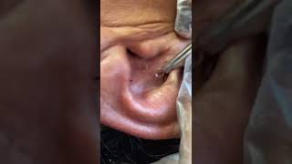 Blackheads In Ear