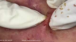 Big Cystic Acne Blackheads Extraction Blackheads & Milia, Whiteheads Removal Pimple Popping