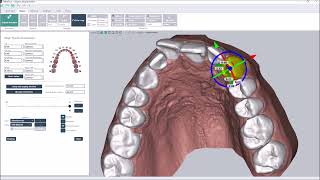 Direct printing of aligners - Deltaface orthodontic software