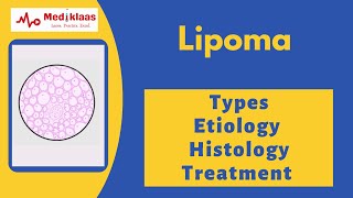 Lipoma - Types, Etiology, Histology and  Treatment l General surgery l Mediklaas