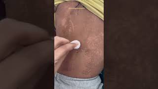 Case of Dermatitis Neglecta #dermatology #medicalshorts #explorepage #viralvideo l