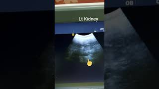 Largest Ovarian Tumour , ovarian tumour ultrasound and specimen ورم علي المبيض كبير الحجم