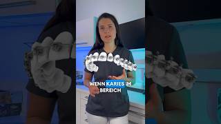 Zahnspangen&Karies 🦷 #zahnarzt #dentist #zahnmedizin #wuppertal #zahnspange #karies