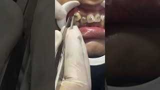 braces treatment