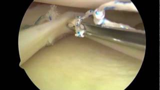 Arthroscopic Knee Surgery Meniscectomy vs Meniscus Repair Dr. Eric Janssen