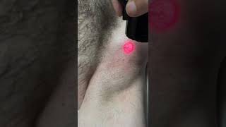 Laser hair removal on a man  underarms