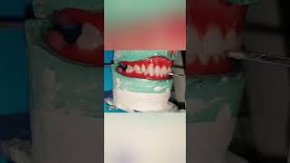 complete denture characterization cross bite