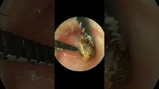 Peeling Sticker-Like Earwax