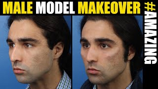 Male Model Makeover with Facial Filler by Dr. Steinbrech #17