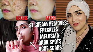 This Cream REMOVES Freckles, Melasma, Dark Spots, Hyperpigmentation + ACNE SCARS! ~ Immy