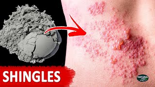 How to Get Rid of Shingles | Shingles Treatment at Home