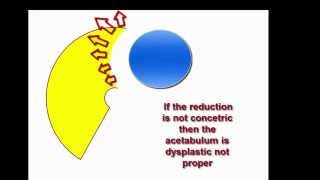 Not concentric reduction of femoral head in acetabulum leads remodeling off target position