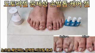 도토리젤 문제성 손발톱 케어 젤로 눈으로 확인하는 강력한 리프팅 효과! 집에서도 간편하게 케어하는 아프고, 피나고, 불편한 손발톱