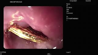 Endoscopic  foreign body removal from esophagus  in a 9 months old child