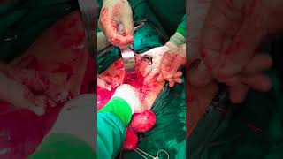 Mass reaching Xiphisternum , hysterectomy total