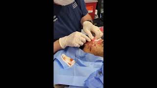 Dr. Dean Kane - Threads for Acne Scars Part 3