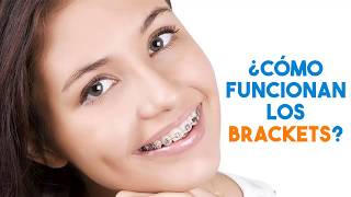 BRACKETS EN LIMA: ¿Cómo funciona la Ortodoncia con Brackets?