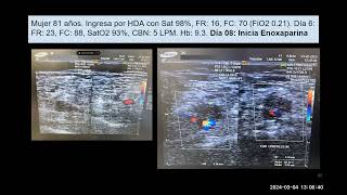 POV: ¿En los hospitales hay pocos casos de TEP?