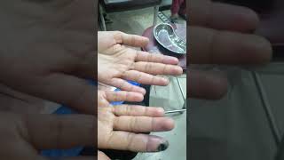 Raynaud's Phenomenon in Systemic Sclerosis