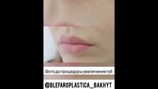 Увеличение губ @blefaroplastica_bakhyt филлерами! Гиалуроновая кислота