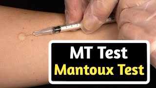 मैनटॉक्स परीक्षण (mantoux test in hindi) || MT test || एमटी टेस्ट क्या है?