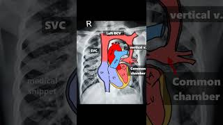 Spot Diagnosis CXR (Part 1) #shorts #cxr #medical_snippet