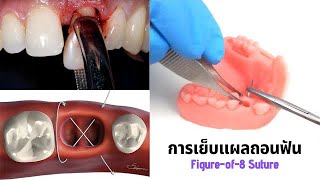 การเย็บแผลถอนฟัน figure eight suture