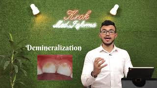 التسوس و اسبابه و كيفية تجنبه (Dental caries, reasons, and how to avoid it)