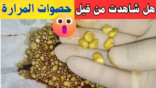 Treating gallstones with surgery  شاهد شكل الحصوات التي تتكون في المرارة