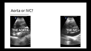 Aorta Versus The IVC