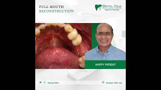 Full mouth Reconstruction for worn out Teeth