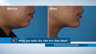 How to Make Your Chin Ideal - Dr. Bahman Guyuron