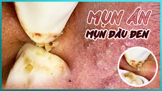 Big Cystic Acne Blackheads Extraction Blackheads & Milia, Whiteheads Removal Pimple Popping