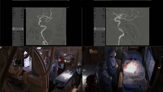 Balloon angioplasty and wingspan stenting for intracranial ICA stenosis