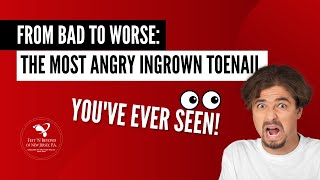 From Bad to Worse: The Most Angry Ingrown Toenail You've Ever Seen!#IngrownToenailHorrorStory