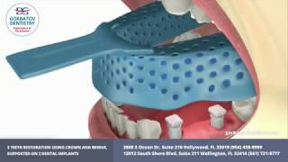 3 teeth restoration using crown and bridge, supported on 2 dental implants