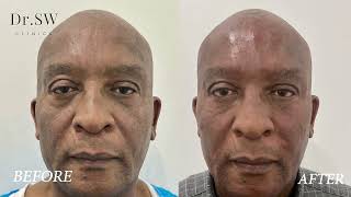 Jim's Before and After Liquid Facelift With Dermal Filler Testimonial | Dr SW Clinics