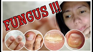 BAKIT NGA BA  NAGKAKA-FUNGUS ANG KUKO |MGA DAHILAN | MGA HOME REMEDIES +TIPS |ROXANNE HERRERA